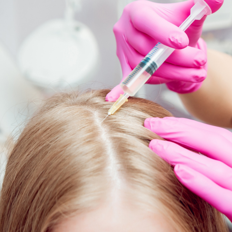 Mezoterapia igłowa – zabieg na włosy